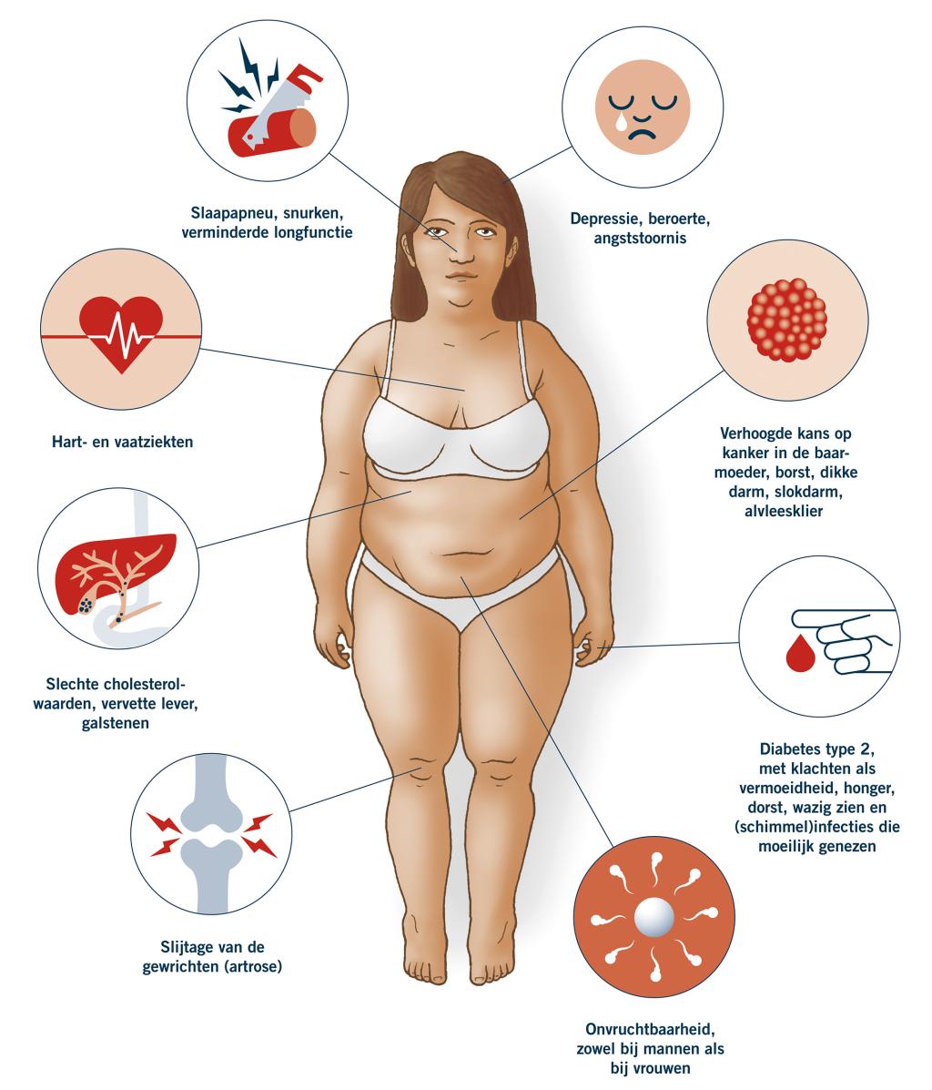 Obesitas illustratie gezondheidsrisico's