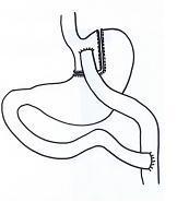 Operatiemethode gastric bypass