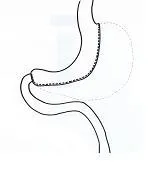 Operatiemethode sleeve resectie