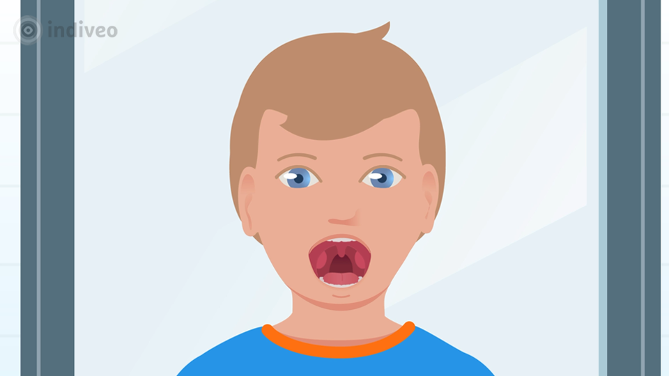 Verwijderen van amandelen (kinderen)