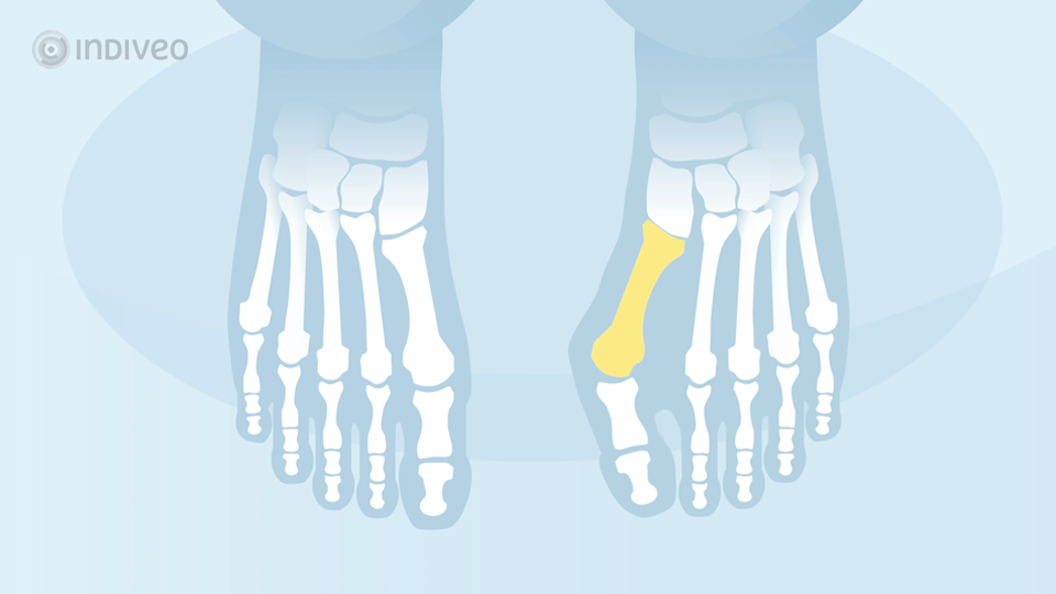 Operatie aan scheve grote teen (hallux valgus)