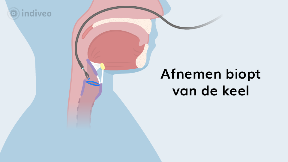 Afnemen biopt van de keel