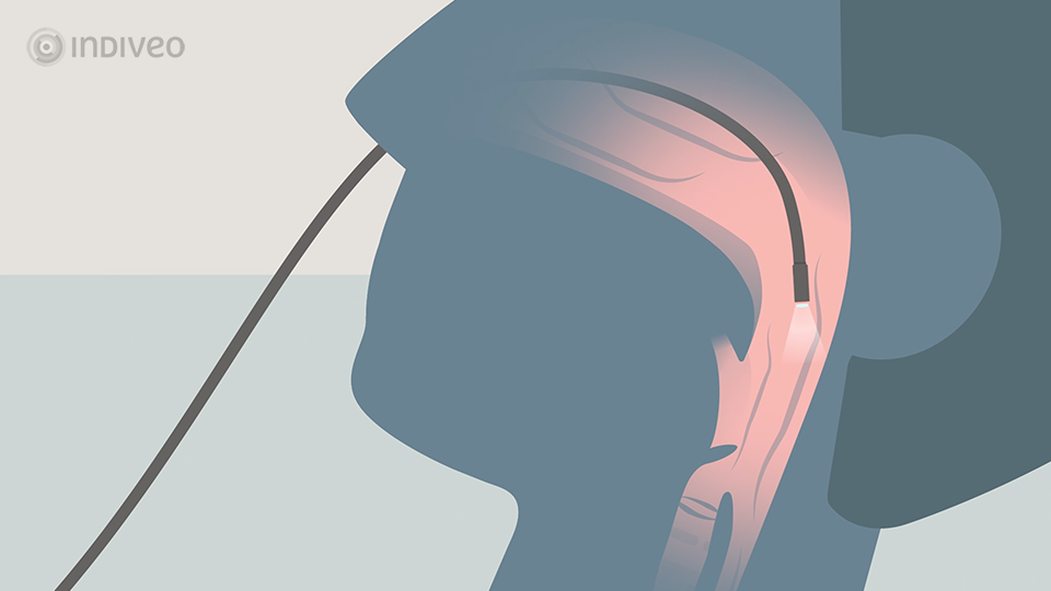 Flexibele scopie (1)