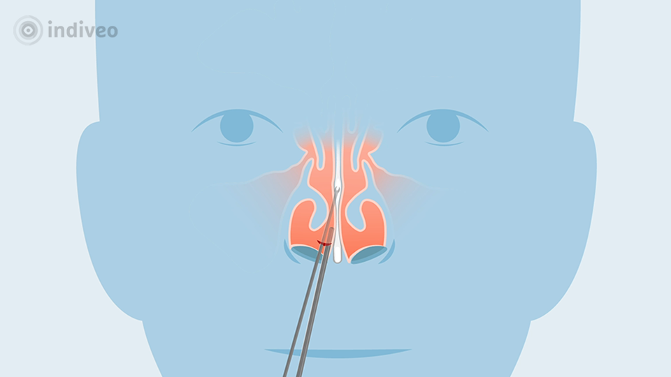 Operatie neustussenschot (Septumcorrectie)