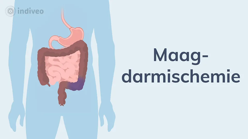 Digitale folder maagdarm-ischemie